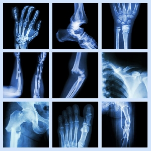 Types Of Fracture